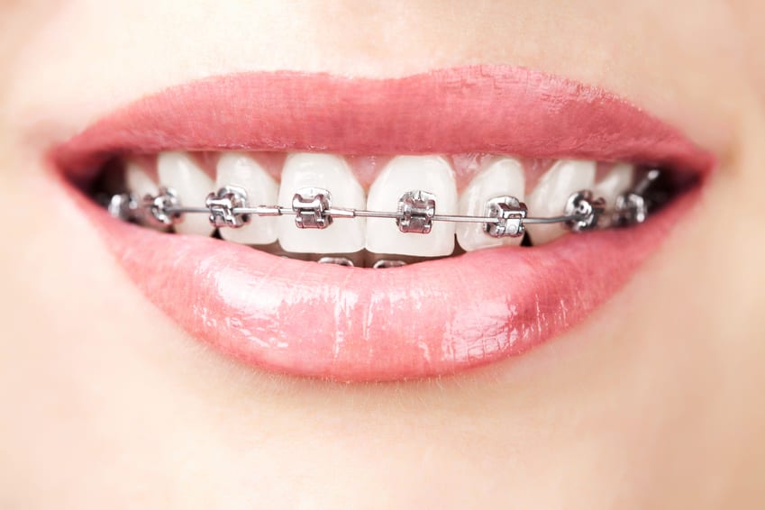A patient's mouth showing metal braces on their upper teeth